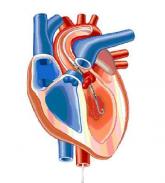 FDA approves miniature heart pump for use during high risk PCI